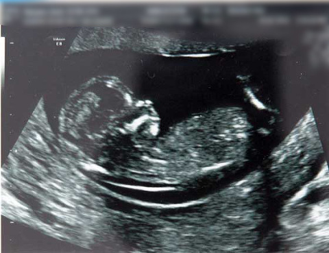 Ultrasound image of baby 13 weeks scanned Maternity photos