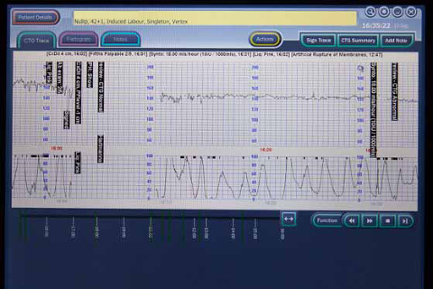 Monash medical centre labour contraction cycles birth photography melbourne