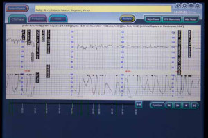 Monash medical centre labour contraction cycles